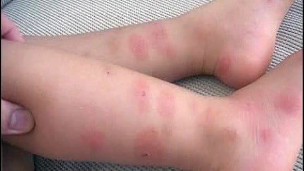 طبيب أطفال يحذر من انتشار الحساسية الحشرية بين الأطفال خلال الصيف